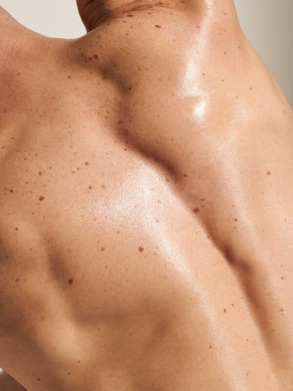 SHR laser hair removal